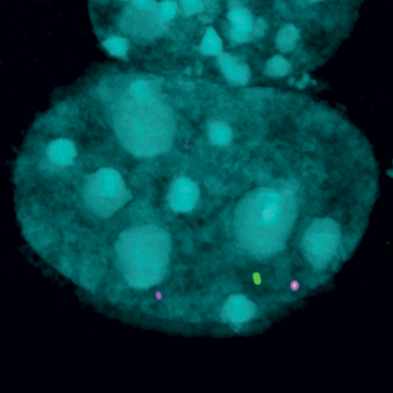 SMCHD1 is involved in gathering pieces of DNA together. In the image two of these pieces are marked with magenta and green dots, while all the DNA is marked in turquoise. When SMCHD1 has gathered two pieces together you see a magenta dot with a yellow centre, indicating the magenta and green dots are at the same place, mediated by SMCHD1. Credit: WEHI