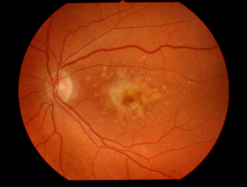 Macular Degeneration Fundus By Tmhlee - Own work, CC BY-SA 3.0