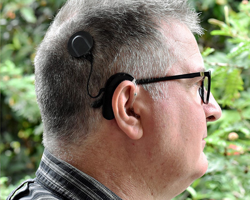 Cochlear_implant_user By Hear hear! - Own work, CC BY-SA 4.0