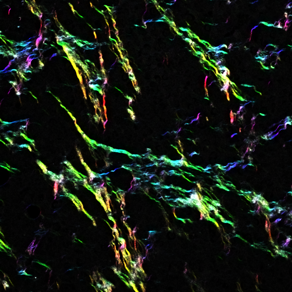 Collagen fibres running through a cancer tumour, created using a multiphoton microscope. The colouring is a visual representation of how collagen fibres are organised.  Changing levels of collagen XII alters this organisation; increasing collagen XII produces collagen fibres that are thicker and more aligned.  Credit: Matrix and Metastasis Lab, Garvan Institute of Medical Research