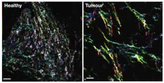 Comparison of healthy and tumour matrix