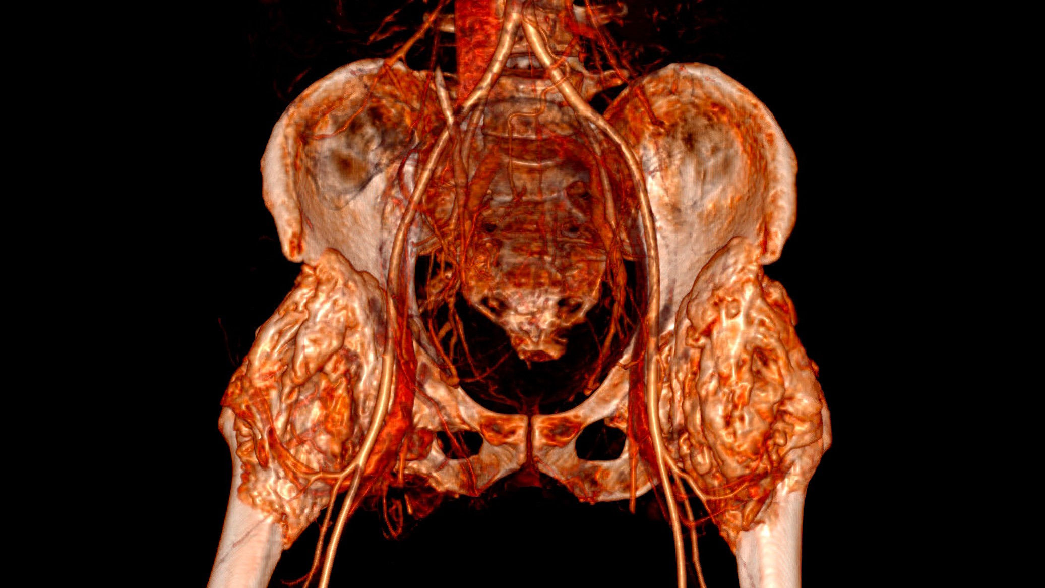 A 3D X-ray scan of hips joints affected by neurogenic heterotopic ossification. 
