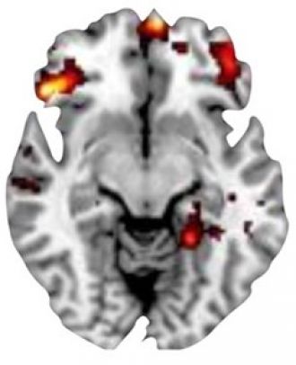 MRI scan showing hyperactivity of orbitofrontal cortex (OFC)
