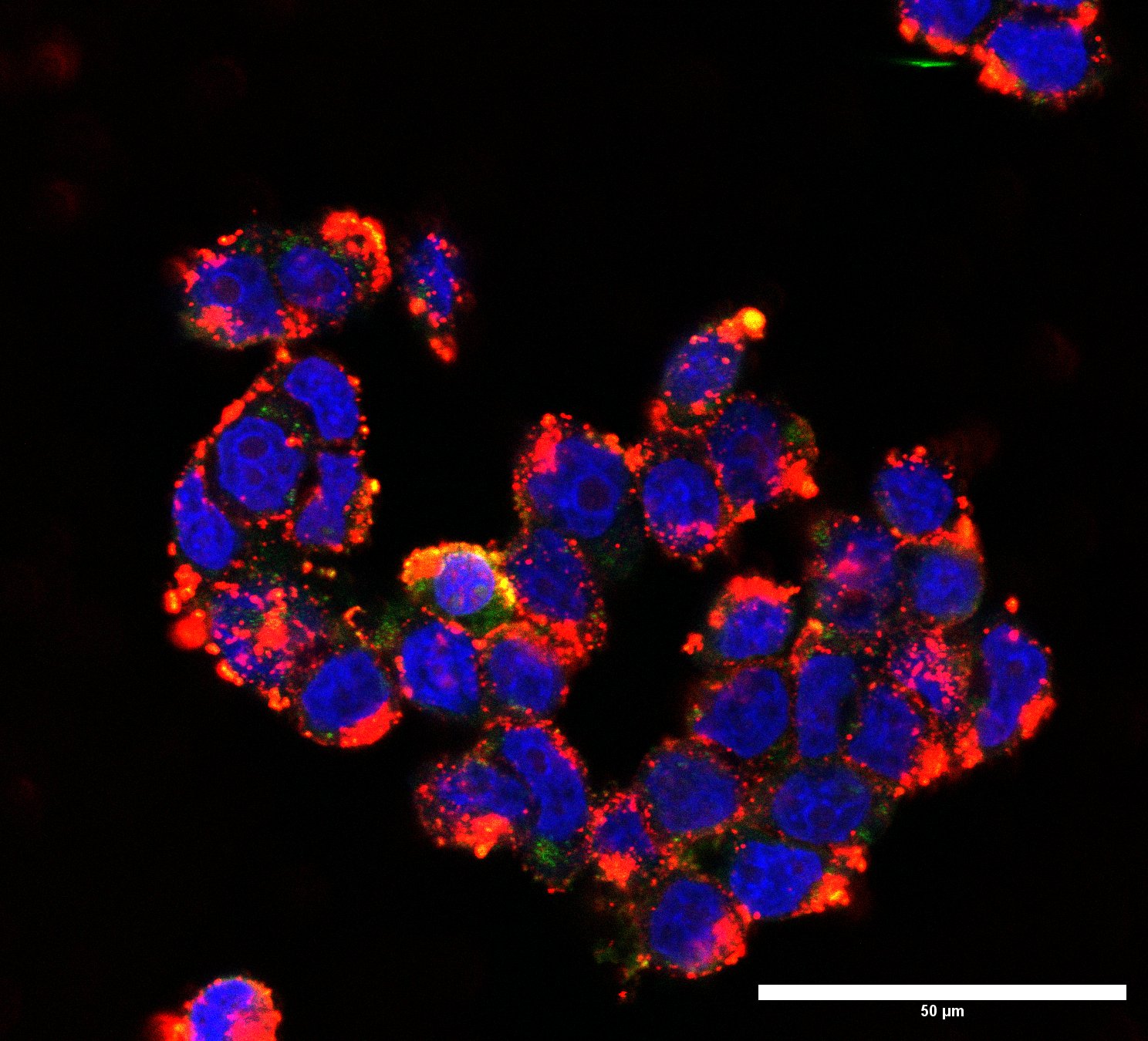 Medulloblastoma cells following delivery of AF647 siRNA via the new nanoparticles designed by AIBN researchers. Photo by AIBN