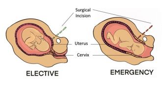 Elective versus an emergency caesarean