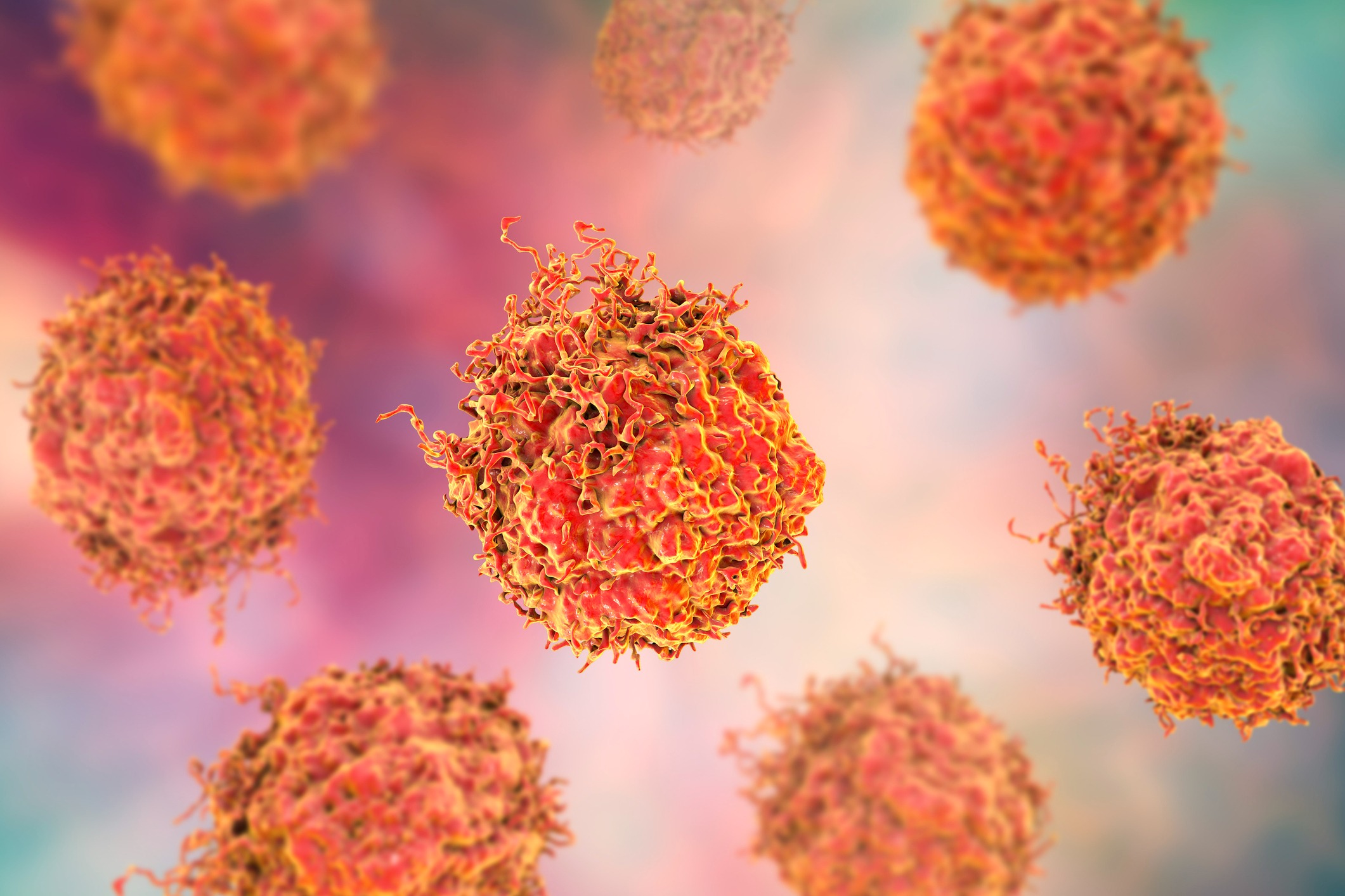 A 3D illustration of prostate cancer cells. Image: iStock