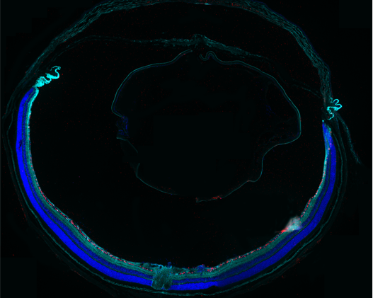High level of TrkB expression (light blue) in retinal ganglion cells following gene therapy with AAV-TrkB-BDNF.  (Courtesy of Andy Osborne)