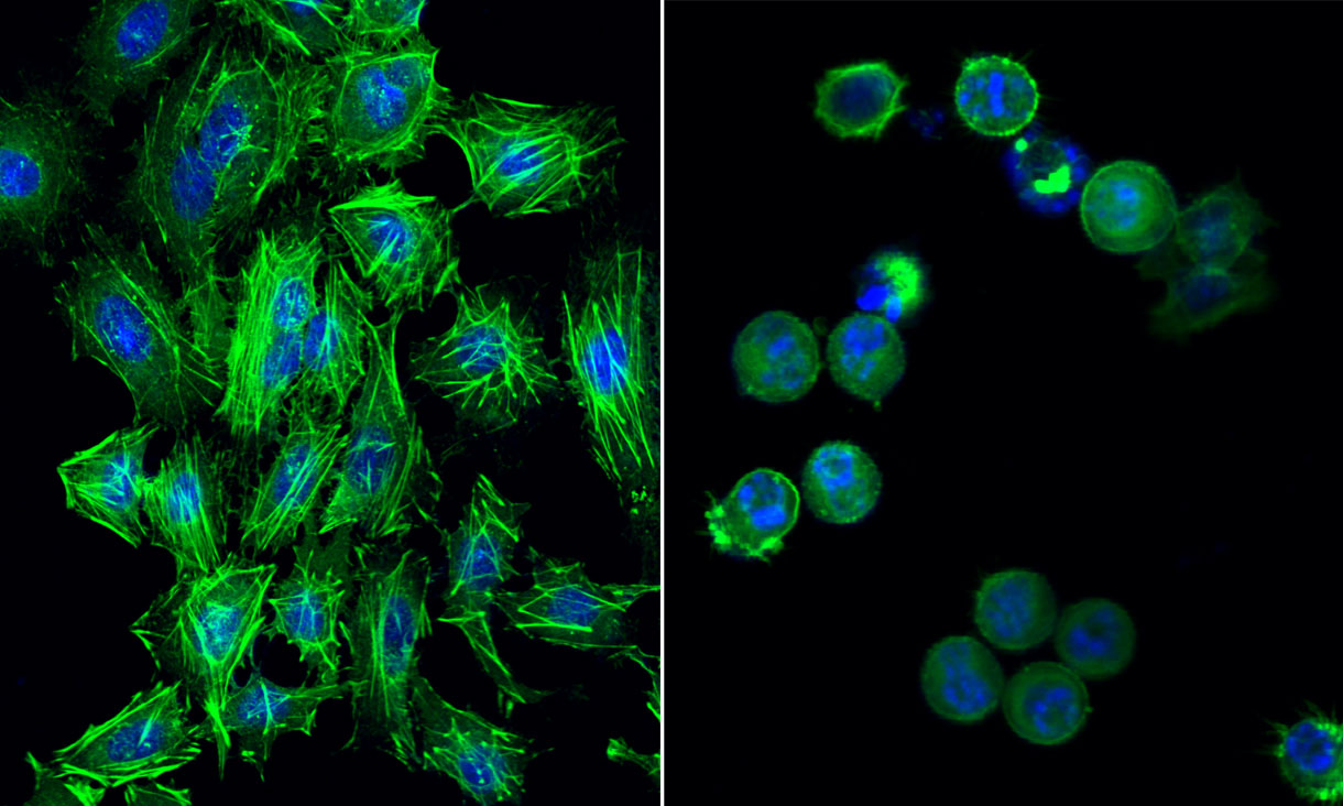 Left: Normal cervical cancer cells with well-formed nuclei in blue and well-organized, elongated actin filaments – which play an essential role in cell survival and division – in green. Right: destabilised cervical cancer cells after gold compound treatment show structural integrity compromised while the nuclei in blue are breaking apart, indicating cell death.Credit: RMIT.