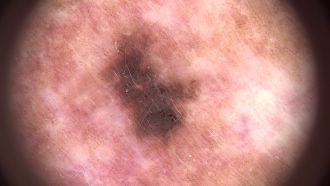 Malignant melanoma on the trapezius