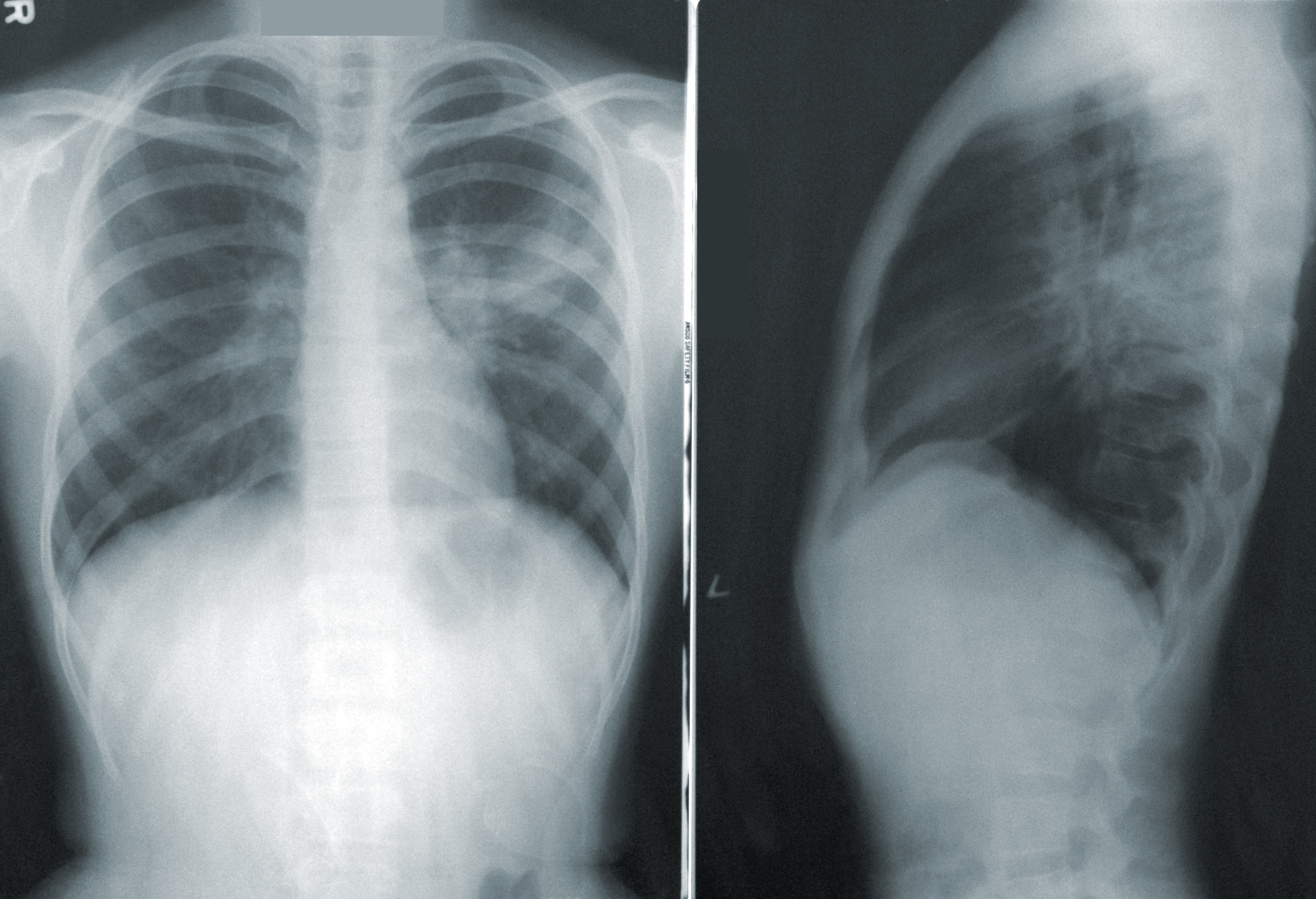 X-Ray showing pneumonia. CDC on Unsplash.