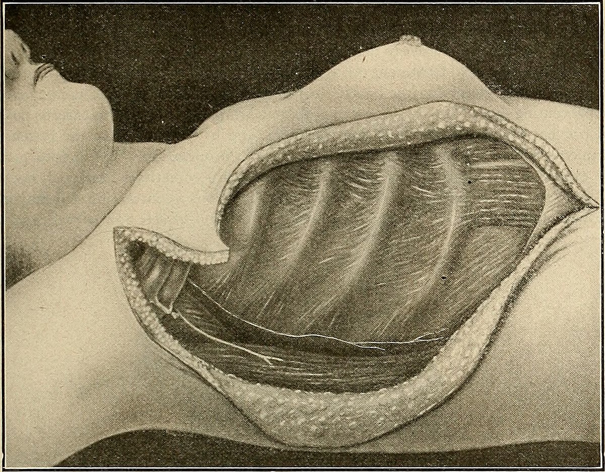 Source: Wikimedia Commons: https://commons.wikimedia.org/wiki/File:The_breast-_its_anomalies,_its_diseases,_and_their_treatment_(1917)_(14570389160).jpg