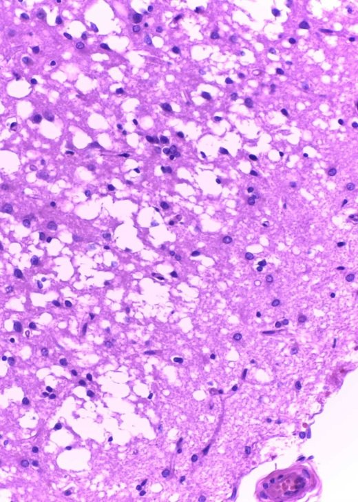 Image of a brain with signs of Creutzfeldt-Jakob disease (CJD).  Picture supplied by The Florey