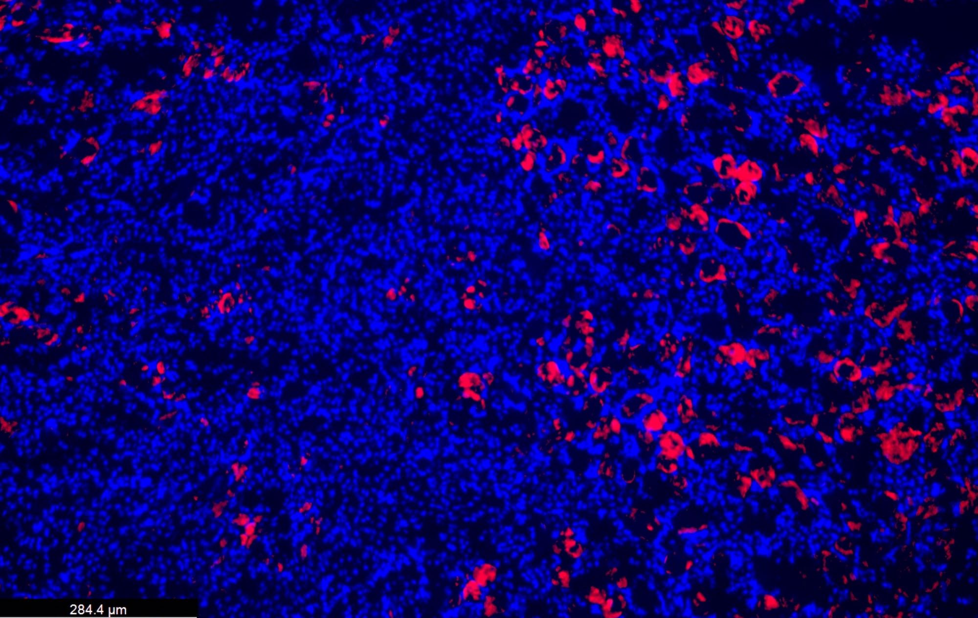 Paradoxically, a gene variant that increases inflammation also has a protective effect on the kidneys. Seen here, kidney cell nuclei (blue) and an influx of immune regulatory cells (pink) that prevent damage in an injured kidney. Credit: Garvan