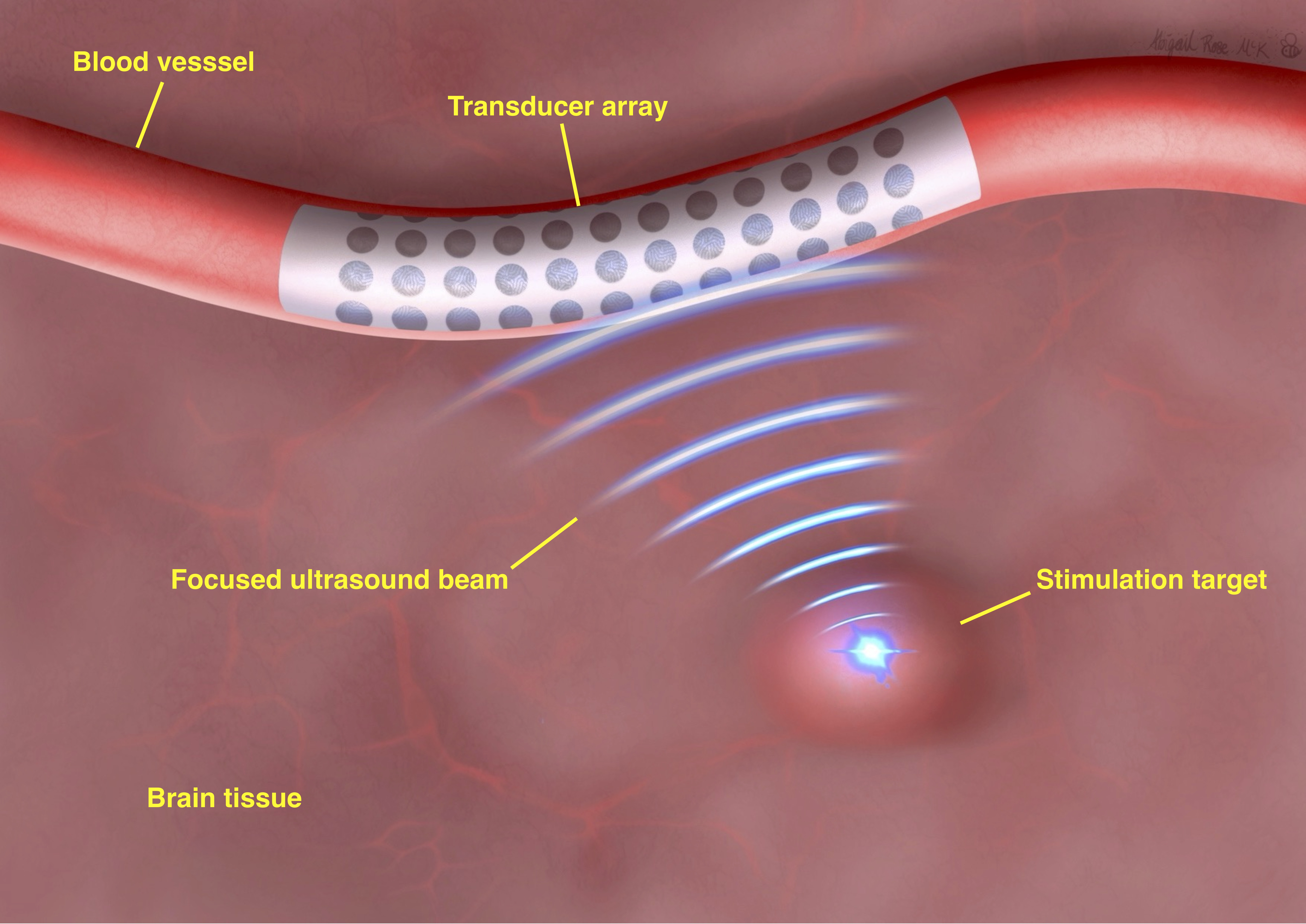An annotated illustration of brain tissue and the proposed project technology.