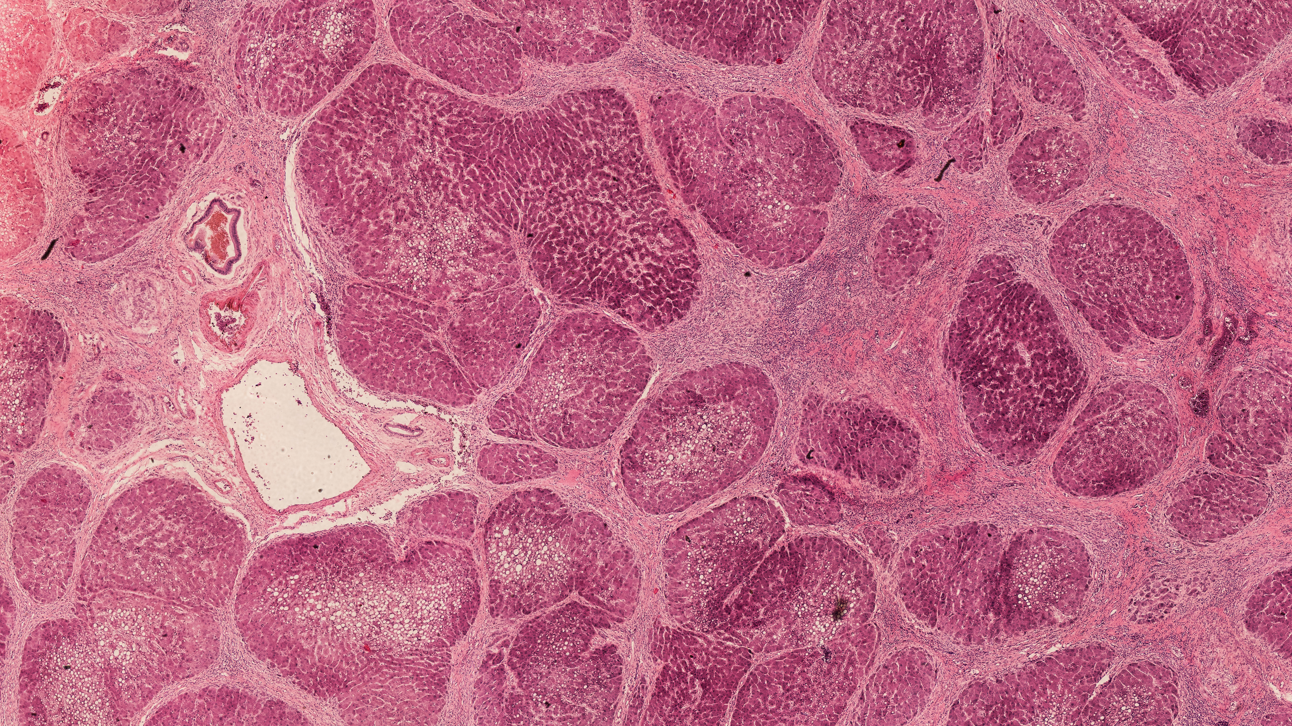 A cross section of liver cirrhosis under the microscope