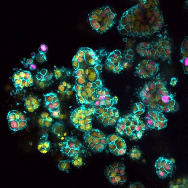 Pictured: 3D structures formed by human pancreatic cancer cells. WEHI researchers are working on developing the first diagnostic test for pancreatic cancer, that could help triple the survival rate of pancreatic cancer by 2030.  Credit: WEHI