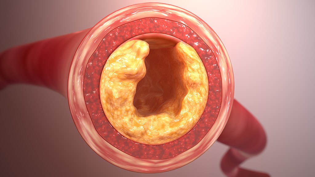 SAG_Clogged-Artery-CS_160421_01 By Scientific Animations, Girish Khera