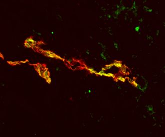 Low Dose Drug-treated Tumour