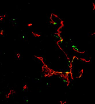 Untreated Tumour vessel