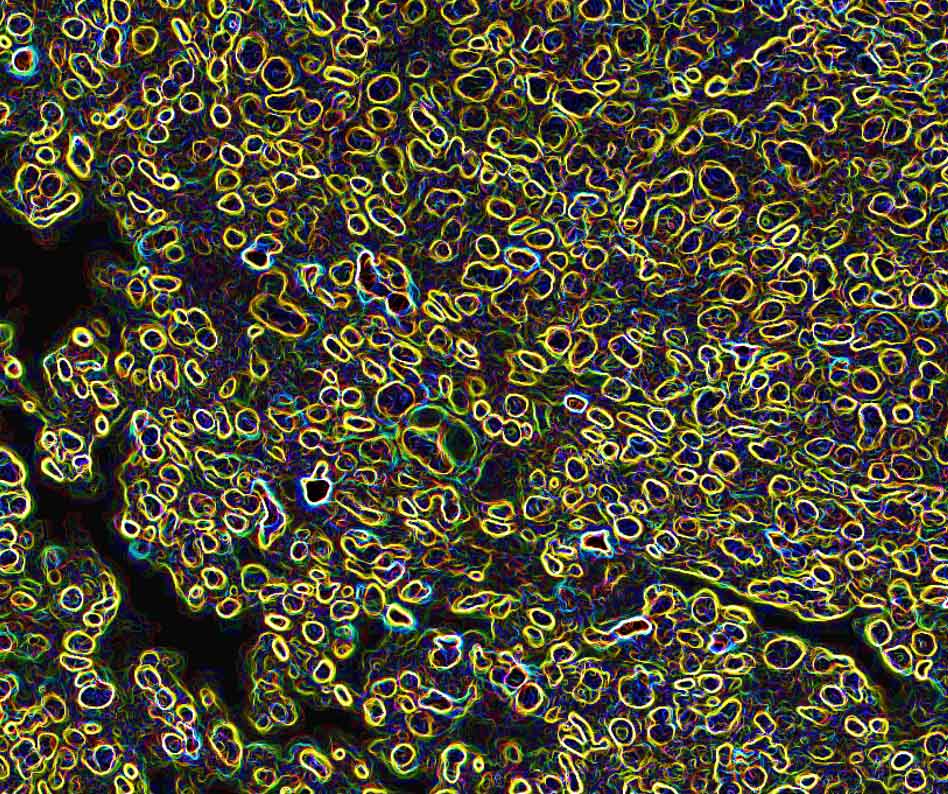 Pictured: A Kras/Lkb1 tumour that has been graphically distorted to capture each cell separately. Researchers have found some cancer and T cells rely on the same energy sources in the complex tumour microenvironment of lung cancer. / Credit: WEHI