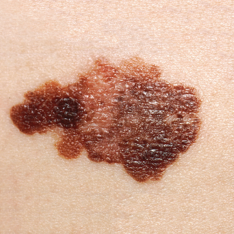 Melanoma By OpenStax College - Anatomy & Physiology, Connexions Web site. Jun 19, 2013., CC BY 3.0