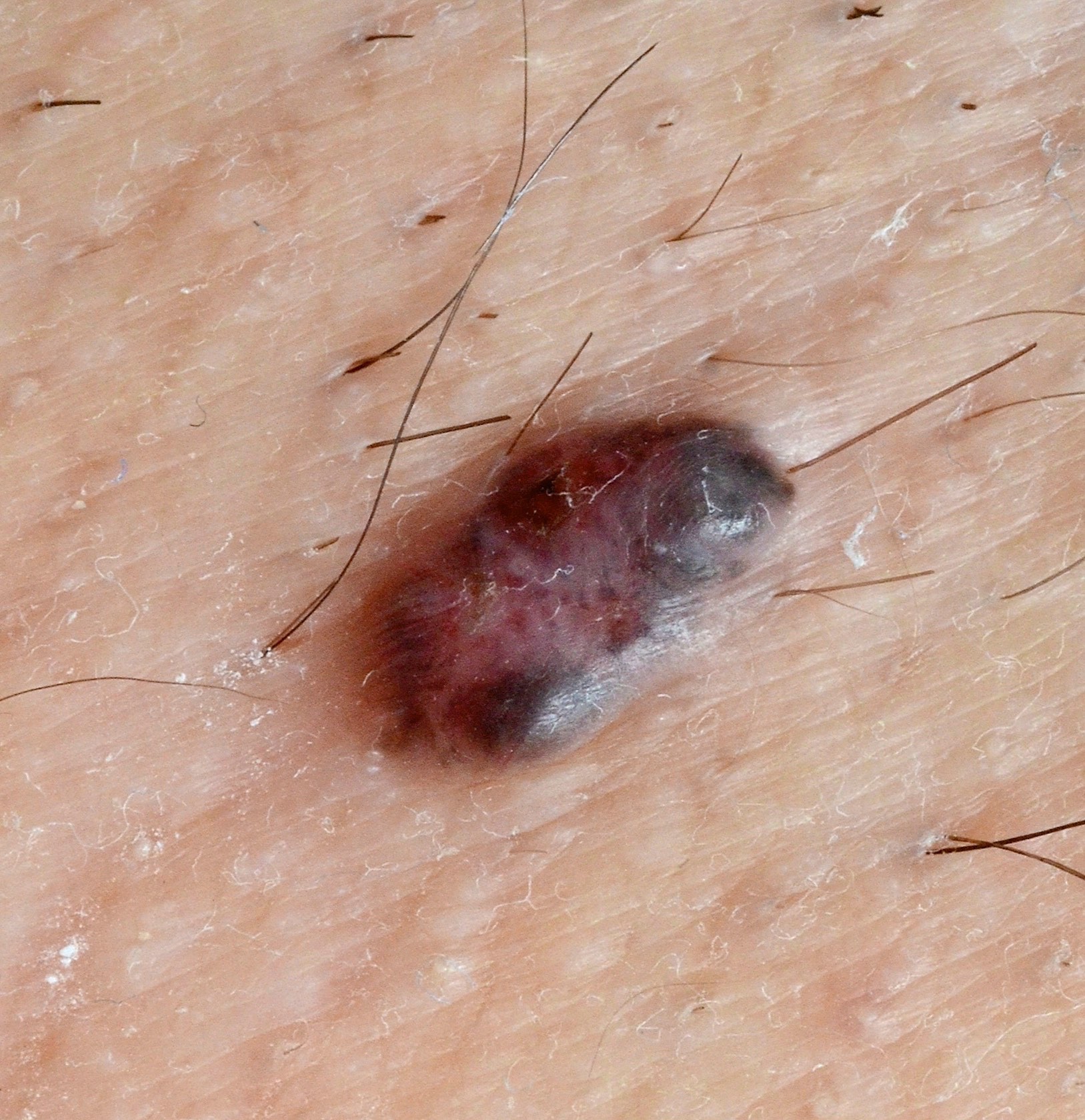 Melanoma Institute Australia Melanoma Institute Australia
