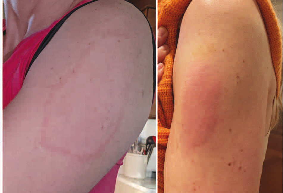 Figure 1. Delayed Localized Cutaneous Hypersensitivity Reactions After the Moderna Coronavirus Disease 2019 Vaccine: Patient with annular pink plaque and patient with edematous pink plaques. CREDIT: Little, et al (JAMA)