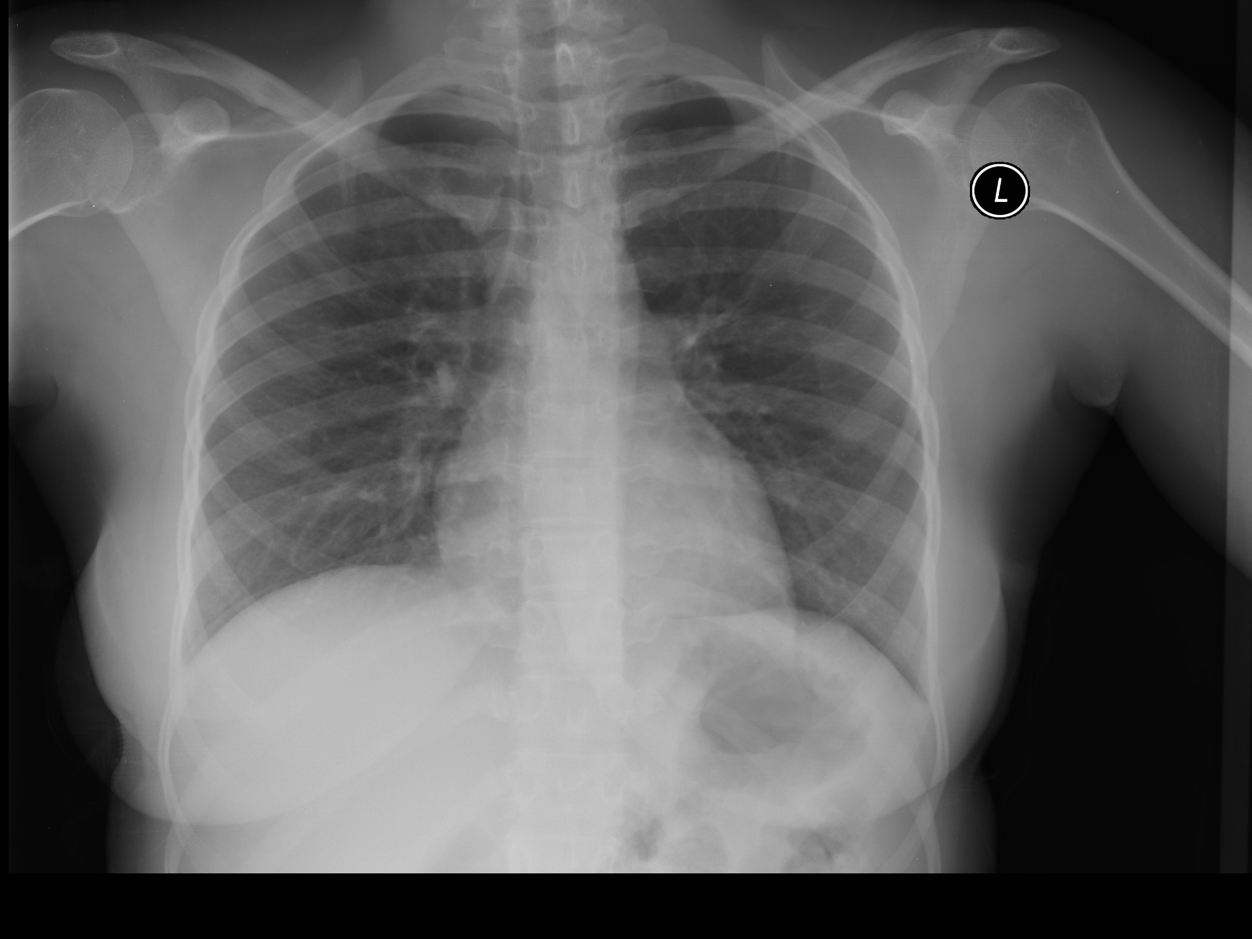 A normal PA chest x-ray. I'mage courtesy Dr. Yale Rosen Atlas of Pulmonary Pathology under CC BY-SA 2.0 Deed license.