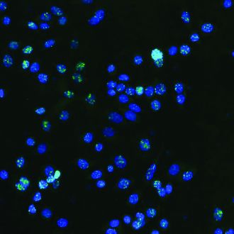 Visualised DNA damage (green) in human breast cancer cells (blue)