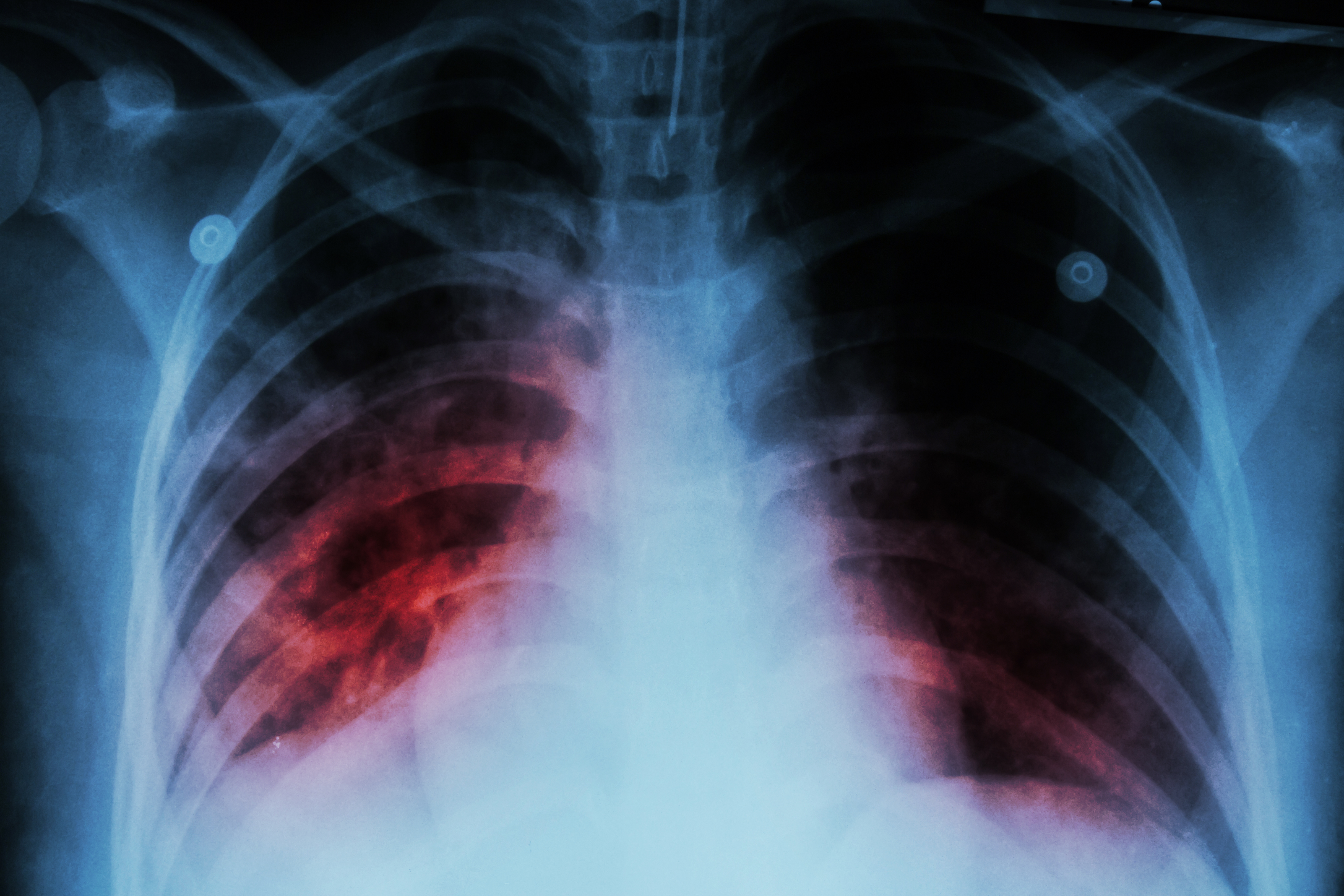 Chest x-ray showing lung inflammation caused by M. tuberculosis infection. 