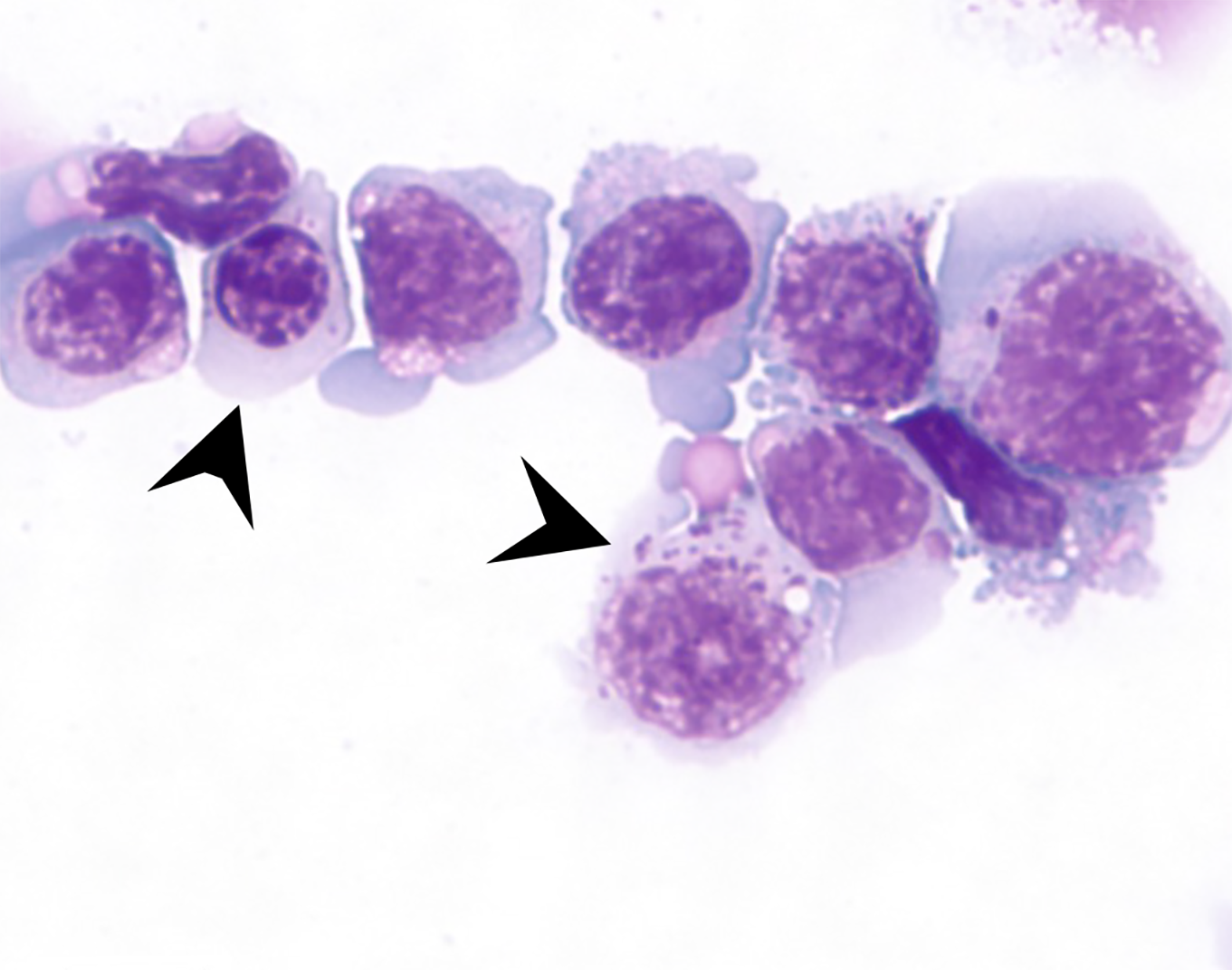 Treatment with a histone deacetylase inhibitor induces production of interferon by immune cells, which causes differentiation of leukaemia cells into normal blood cells and ultimately their death (differentiated cells are marked with an arrow). Credit: Peter MacCallum Cancer Centre