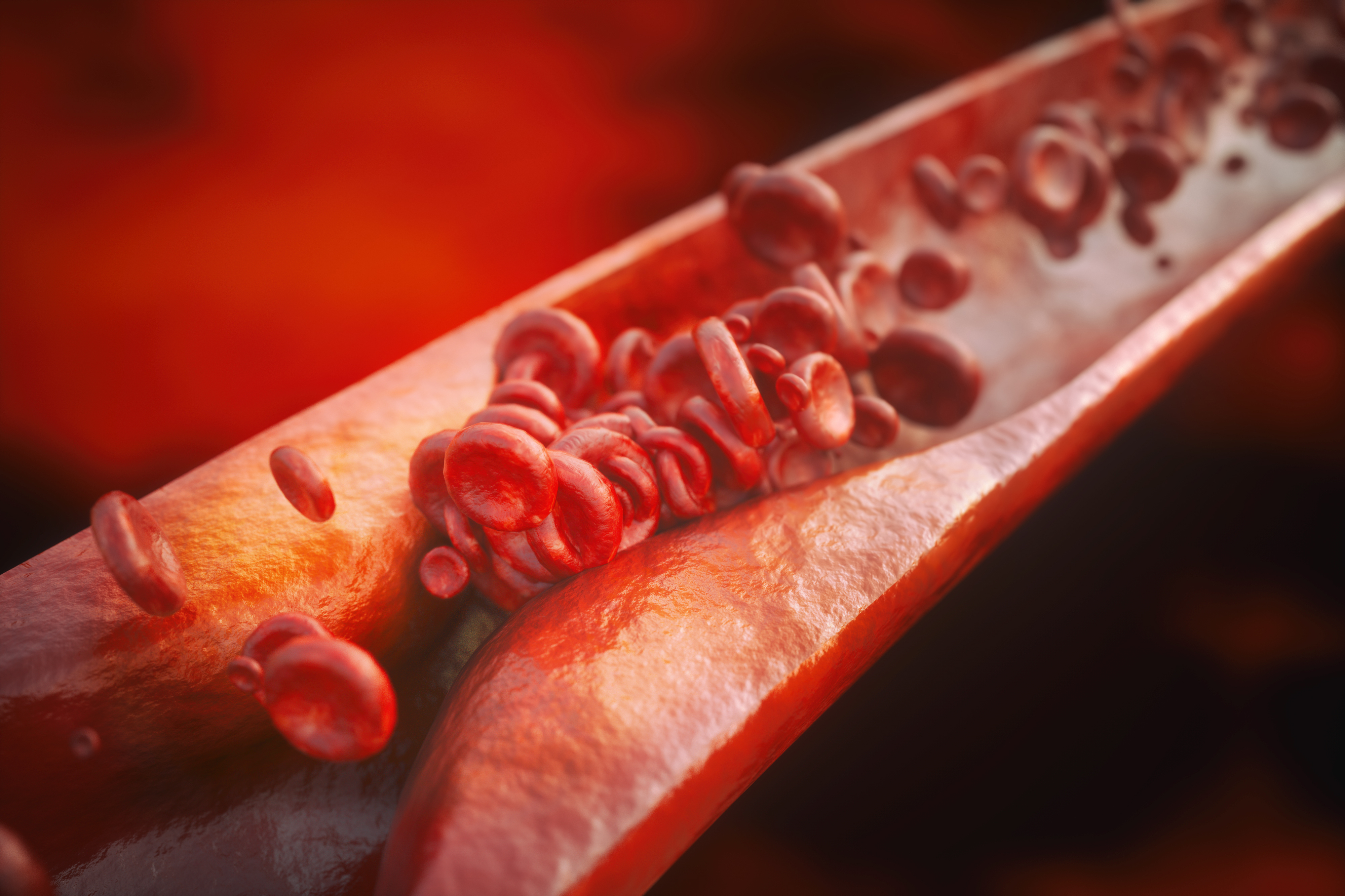 Atherosclerosis or plaque in a vein. Purchased via Shutterstock