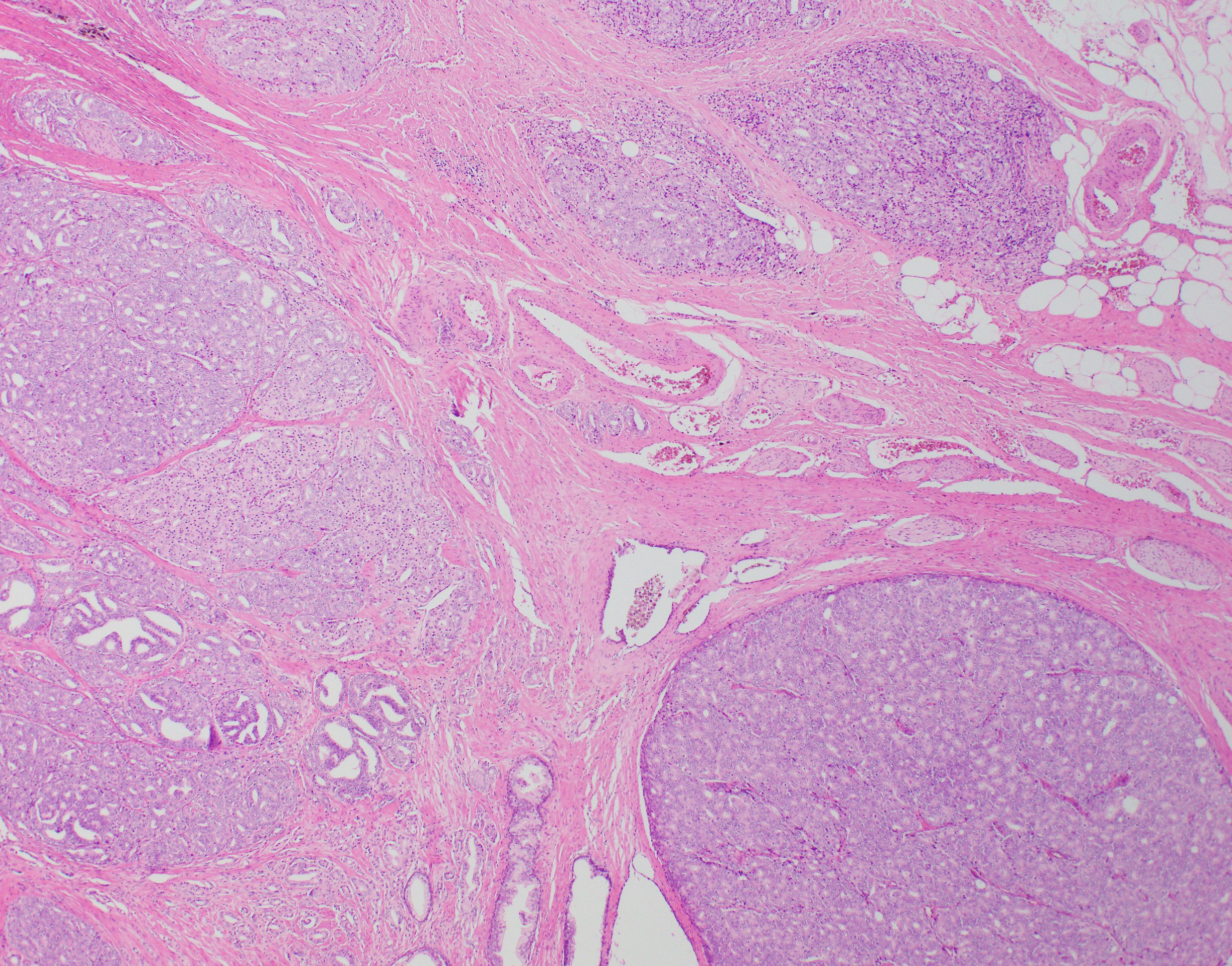 Histopathological image of a high grade prostate cancer. Credit: Prof James Kench