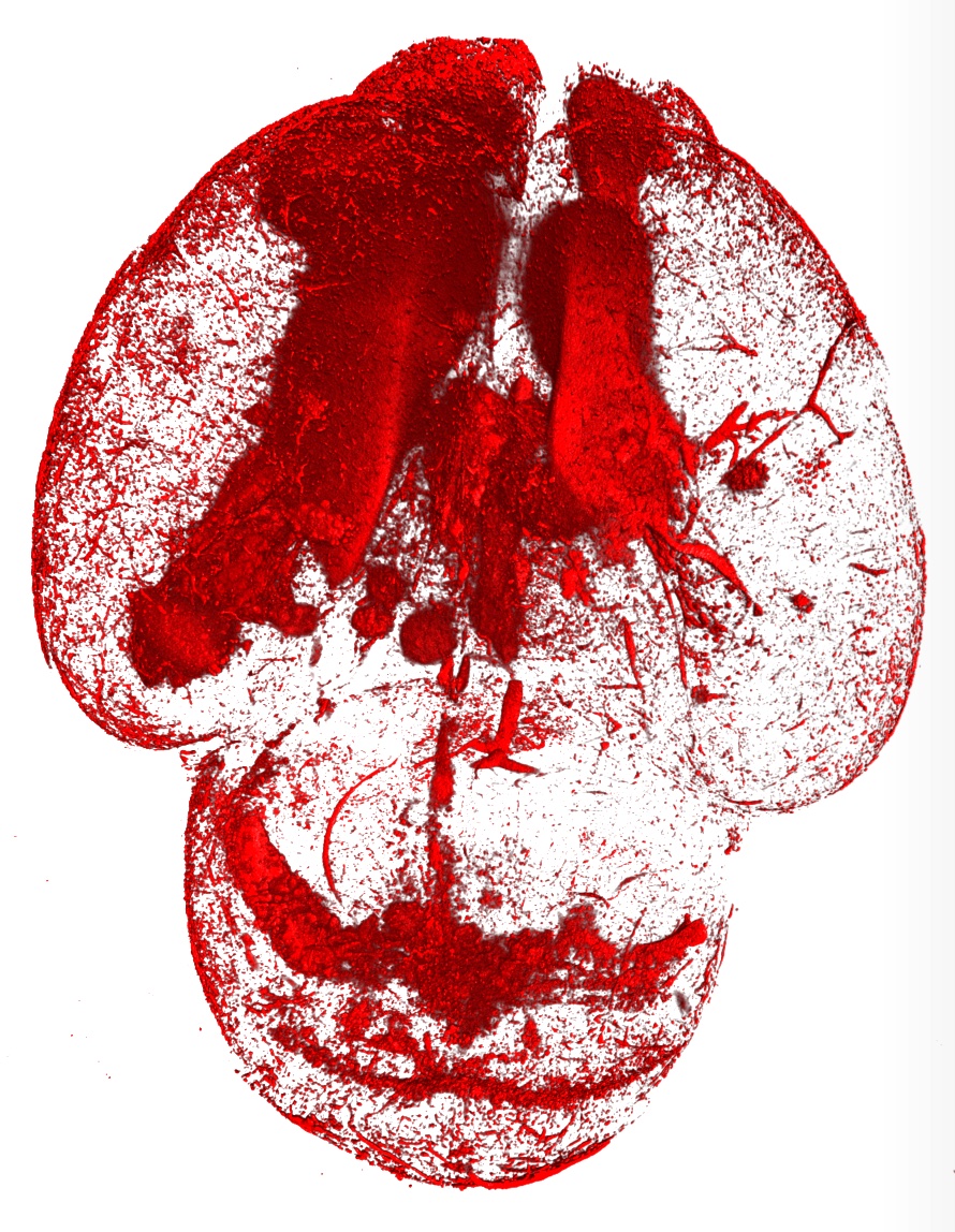 A pre-clinical model showing large areas of the brain with bleeding (blood cells in red)