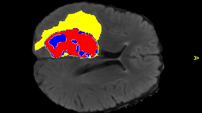 AI-annotated medical image showing enhanced tumour, tumour core and edema regions. Image credit: Monash University