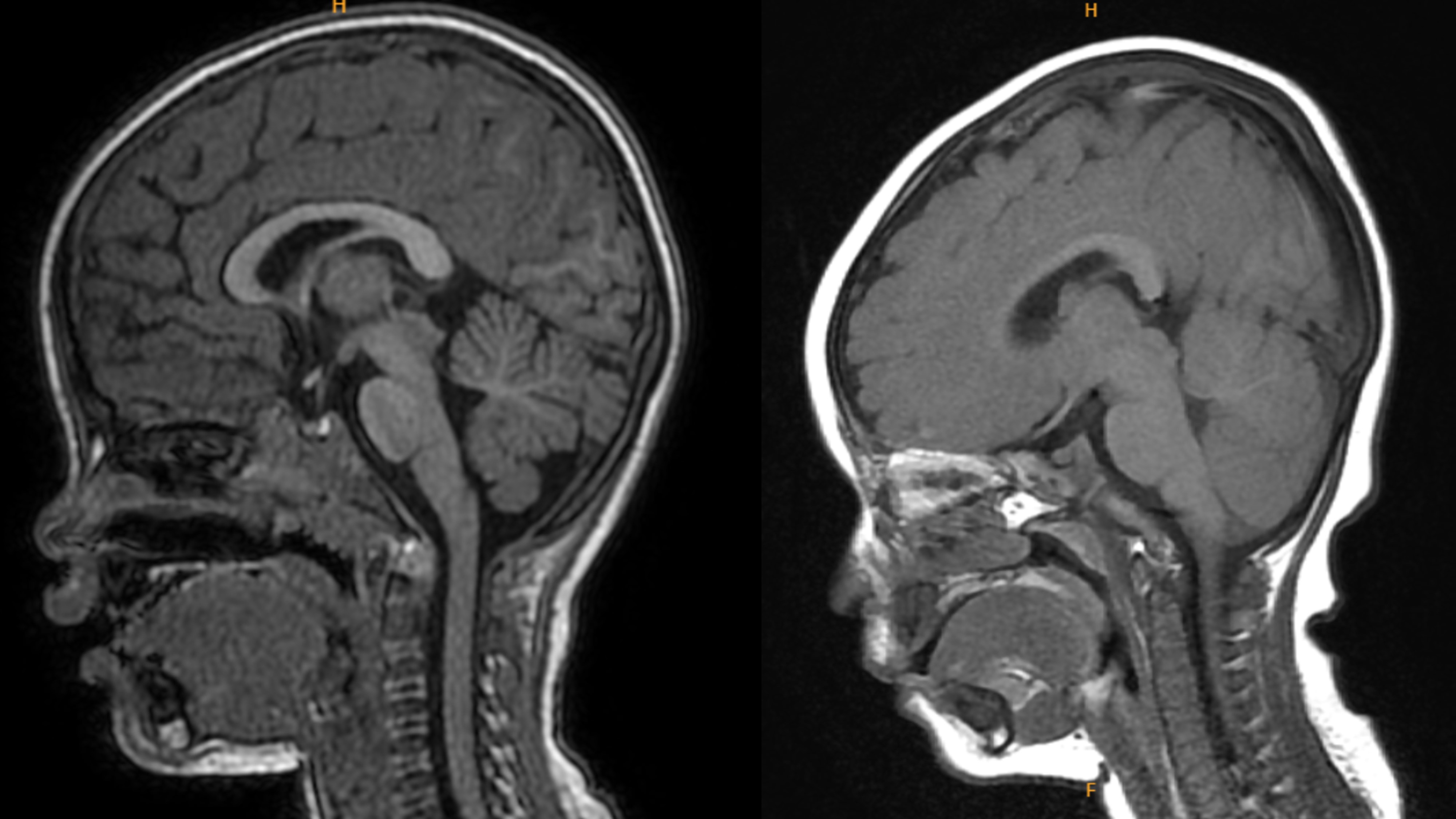 MRI scans from two FOXG1 patients show the brain’s left–right connector (corpus callosum) as a central bright arch visible on the left patient, partially missing in the more severe case on the right. CREDIT: National Yang Ming Chiao Tung University, Taiwan