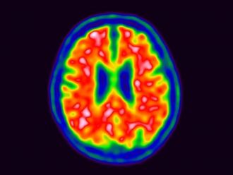 Positron emission tomography (PET) image of a brain with Alzheimer's
