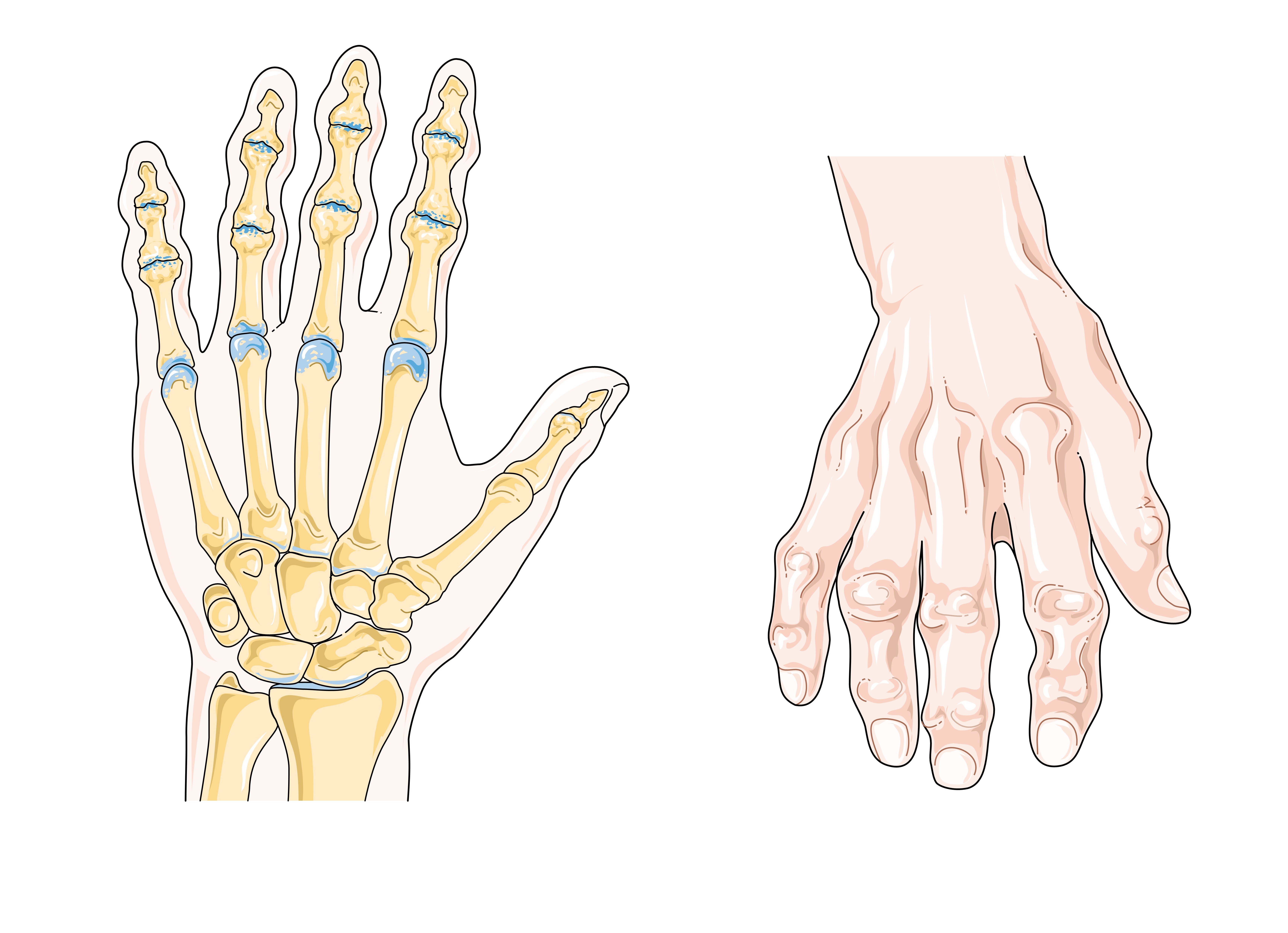 Sourced from Wikimedia Commons: https://commons.wikimedia.org/wiki/File:Osteoarthritis_--_Smart-Servier.jpg