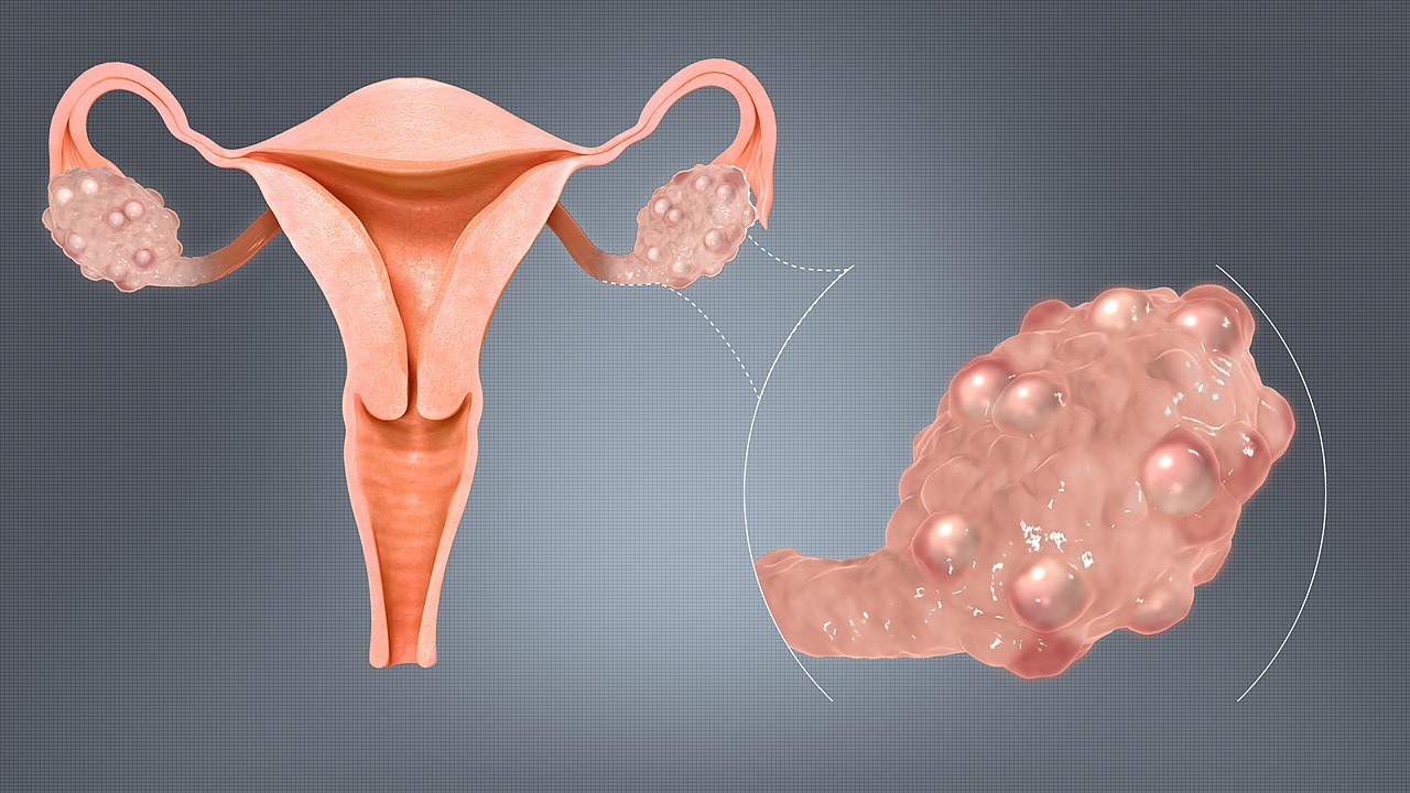 Polycystic_Ovaries By www.scientificanimations.com CC BY-SA 4.0