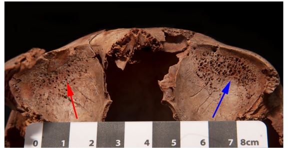 Porous lesions on the bones of the orbital roof. Red arrow indicates small pores in the right bone cortex. Blue arrow indicates exposed trabecular bone on the left.