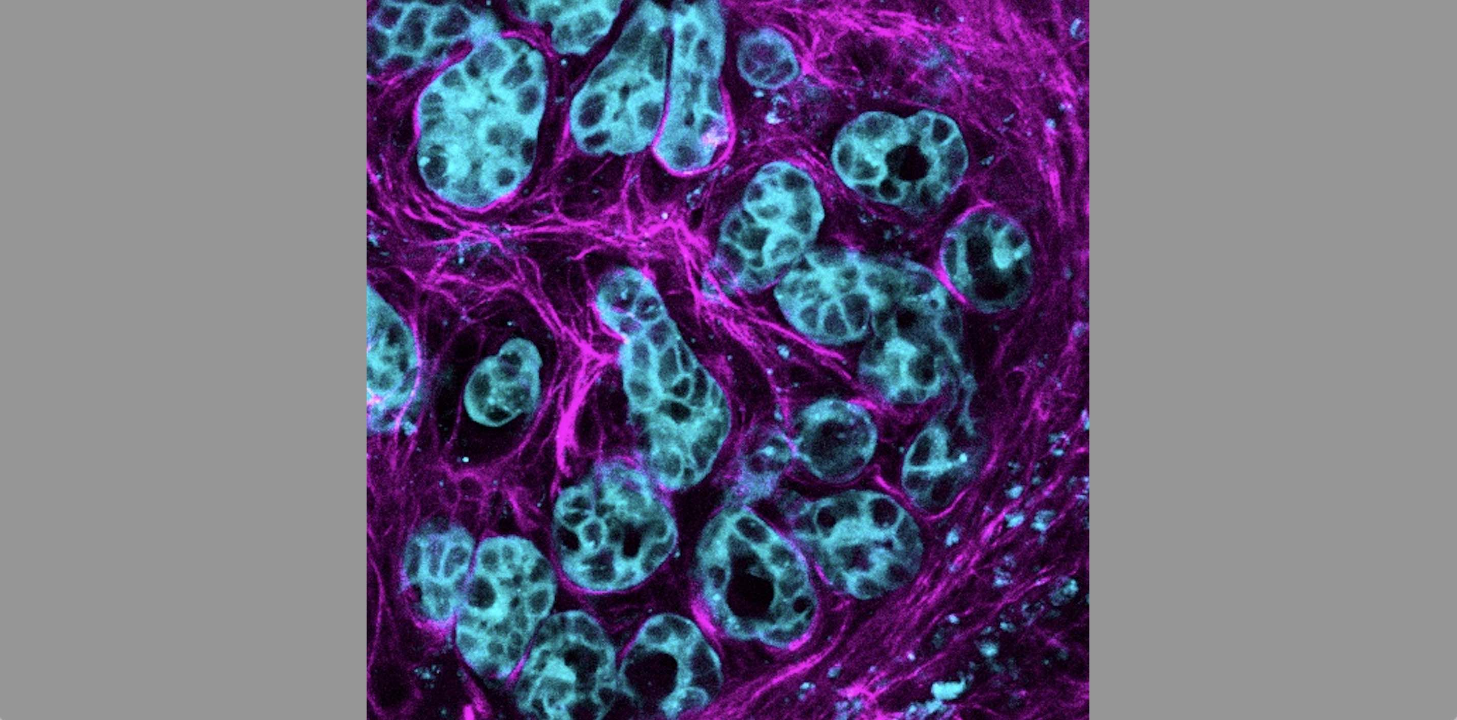 Pancreatic cancer cells activate the molecule AKT (blue) to multiply and spread along connective stroma (pink) in the cancer environment. Credit: Max Nobis (VIB-KU Leuven Center for Cancer Biology)