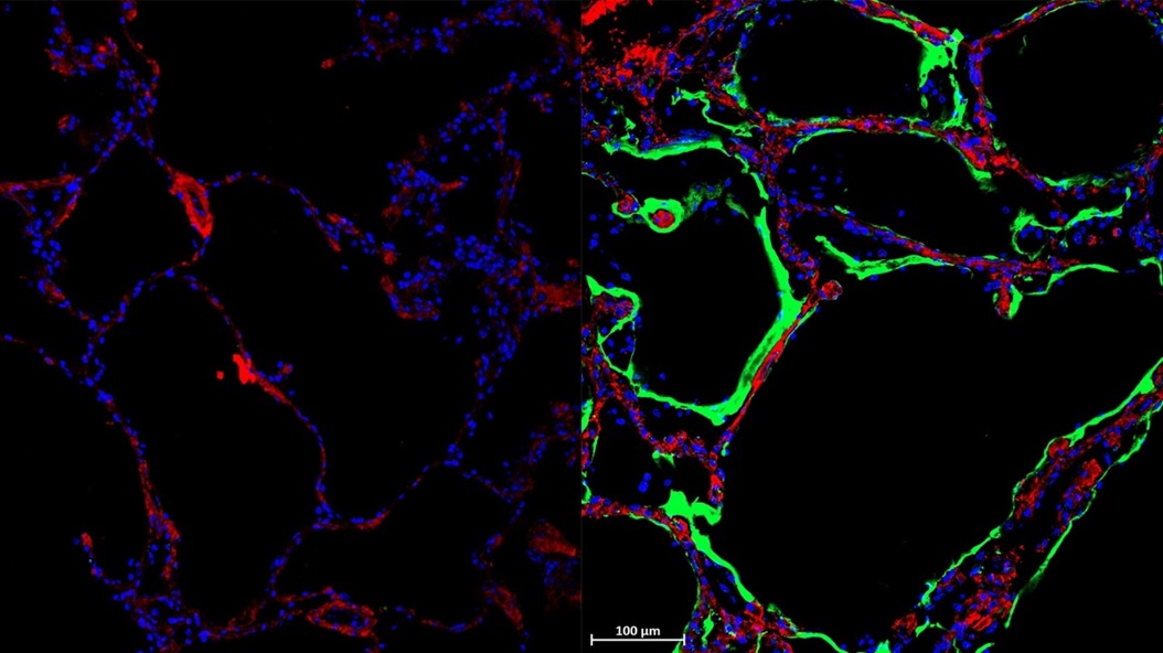Left: Control Lung. Right: Immunofluorescent staining shows expression of new SARS-CoV-2 spike-receptor LRRC15 (green) in post-mortem lung tissue section from individual with COVID-19. [Credit: Loo and Waller et al.]