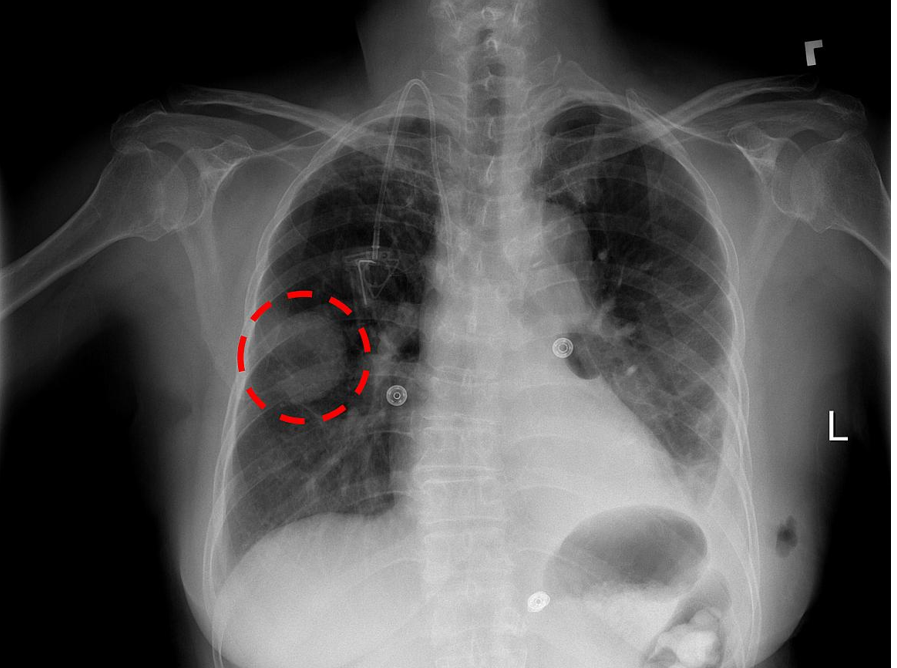 NIH Image Gallery / Flickr - Chest x-ray showing a lung mass - https://www.flickr.com/photos/nihgov/37136227250/in/photolist-YzASyb