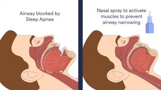 Nasal spray for sleep apnea