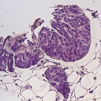 Cancerous tissue viewed on a traditional microscope slide using standard stain