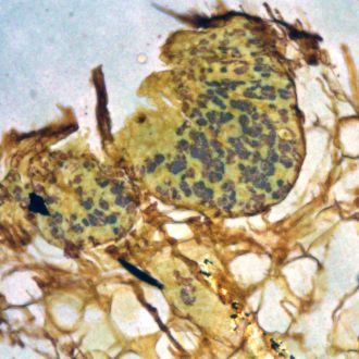 Unstained cancerous tissue viewed using a NanoMslide