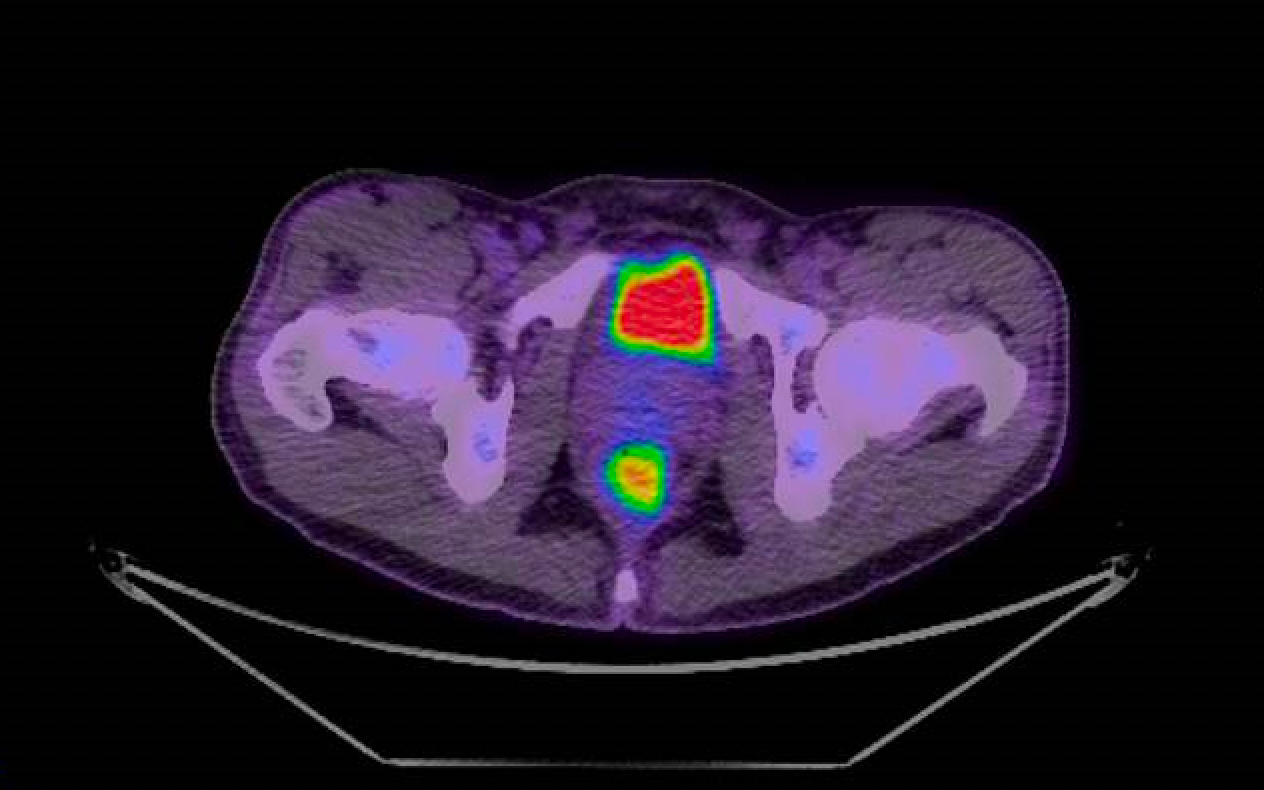 PET scan of the rectum showing site of infection as the lower orange spot. Source: Peter MacCallum Cancer Centre