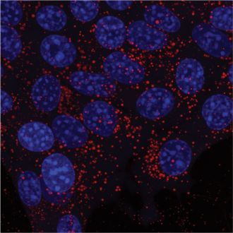 Triple-negative cancer cells stockpiling lipids