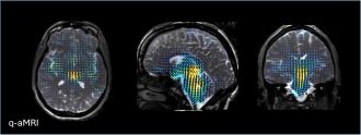  Human brain motion shown via quantitative amplified MRI (q-aMRI)