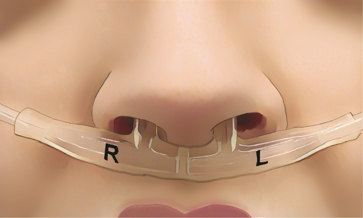 Tubes beneath the nose measured airflow from each nostril, revealing each person’s unique breathing fingerprint. CREDIT Soroka et al., Current Biology